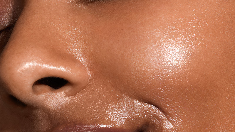 The Acne Crash and Burn